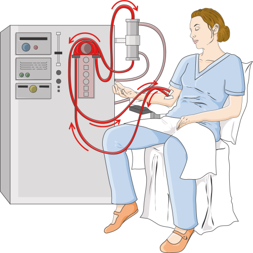 Hemodialysis