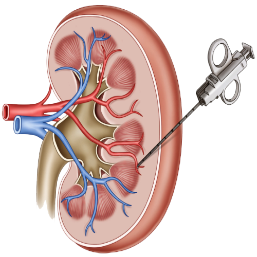 Renal biopsy