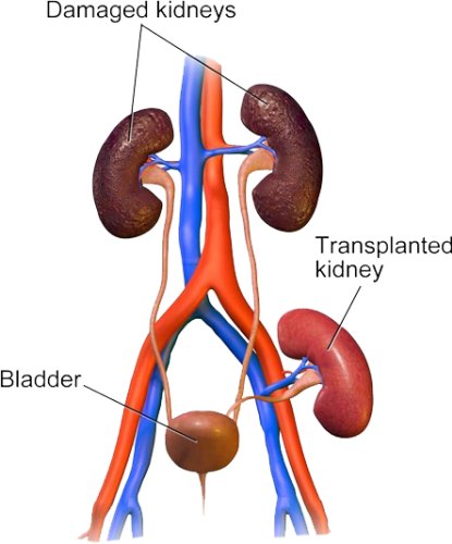 Post renal transplant care