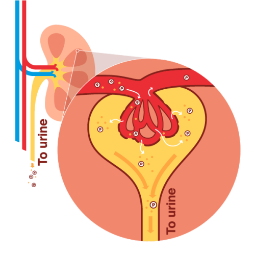 kidney disease in Diabetes