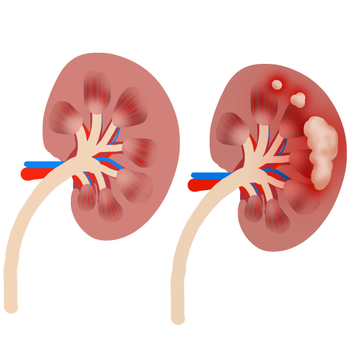 Kidney disease in cancer